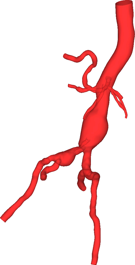 Modelo tridimensional de la aorta abdominal segmentada a partir de imagen medica